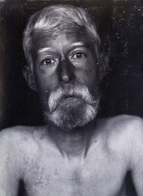 Friern Hospital, London: a patient, facing forwards. Photograph, 1890/1910.