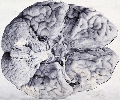 Friern Hospital, London: a brain, seen from underneath. Photograph, 1890/1910.