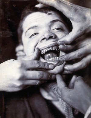 view Friern Hospital, London: a boy with rotten teeth. Photograph, 1890/1910.