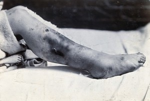 view Friern Hospital, London: a child's leg with marks and sores. Photograph, 1890/1910.