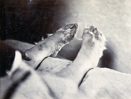 Friern Hospital, London: a child's feet viewed from above. Photograph, 1890/1910.