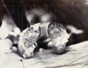 view Friern Hospital, London: a child's feet viewed from below. Photograph, 1890/1910.