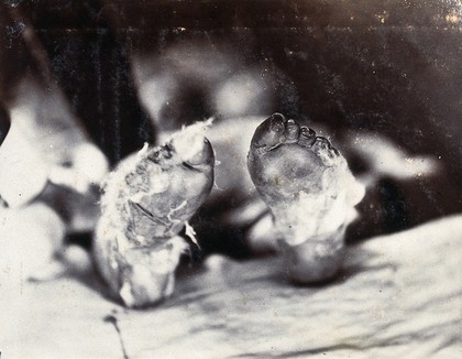 Friern Hospital, London: a child's feet viewed from below. Photograph, 1890/1910.