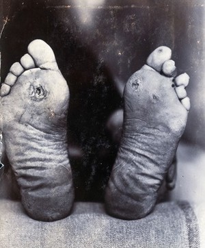 view Friern Hospital, London: the soles of the feet of a lying figure. Photograph, 1890/1910.