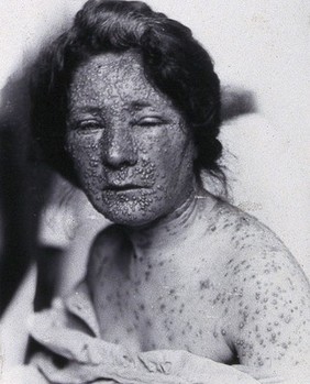 Friern Hospital, London: a woman's arms with spots, possibly smallpox. Photograph, 1890/1910.