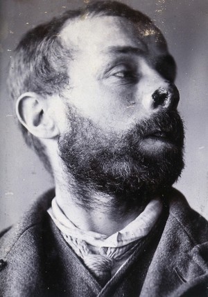 view Friern Hospital, London: a man's face showing tuberculosis of the skin (lupus vulgaris). Photograph, 1890/1910.