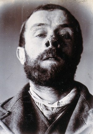 view Friern Hospital, London: a man's face showing tuberculosis of the skin (lupus vulgaris). Photograph, 1890/1910.