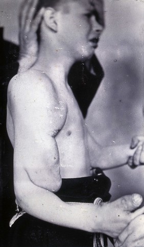 Friern Hospital, London: a boy, viewed from the side, with a growth on his right shoulder, arm and hand. Photograph, 1890/1910.