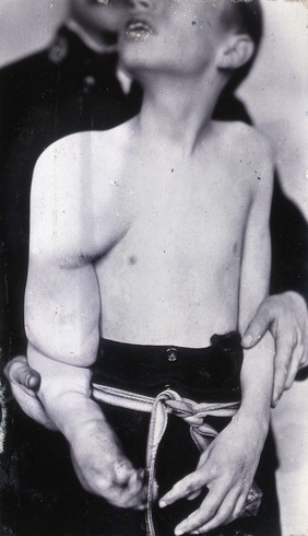 Friern Hospital, London: a boy, viewed from the front, with a growth on his right shoulder, arm and hand. Photograph, 1890/1910.