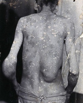 Friern Hospital, London: a man, viewed from behind, with a swelling on his left elbow and the right side of his back. Photograph, 1890/1910.