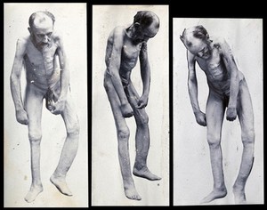 view Friern Hospital, London: an emaciated old man, naked, with deformed limbs and stitch marks running from beneath his chin to his penis; three views from different angles. Photograph, 1890/1910.