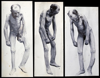 Friern Hospital, London: an emaciated old man, naked, with deformed limbs and stitch marks running from beneath his chin to his penis; three views from different angles. Photograph, 1890/1910.
