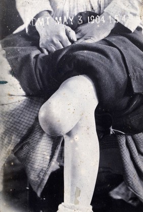 Friern Hospital, London: the knee of a seated person, with a large growth. Photograph, 1890/1910.