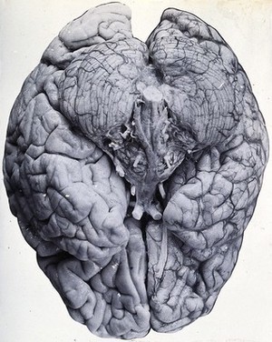 view Friern Hospital, London: a brain. Photograph, 1890/1910.