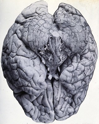 Friern Hospital, London: a brain. Photograph, 1890/1910.