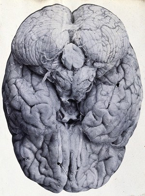 view Friern Hospital, London: a brain. Photograph, 1890/1910.