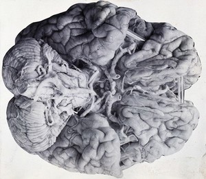 view Friern Hospital, London: a diseased brain, viewed from above. Photograph, 1890/1910.