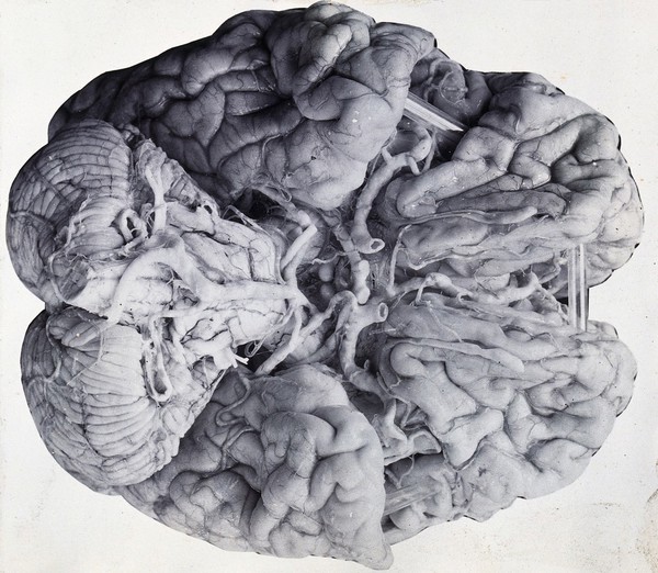 Friern Hospital, London: a diseased brain, viewed from above. Photograph, 1890/1910.