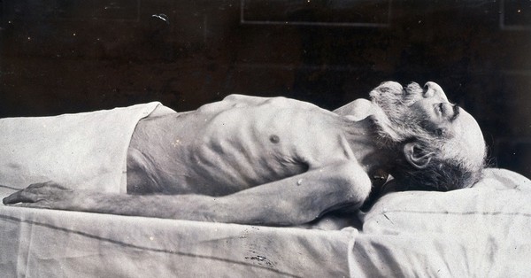 Friern Hospital, London: a dead man on a bed, viewed from the side. Photograph, 1890/1910.