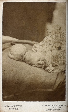 A baby with an encephalocele lying on a bed. Photographs by F.A. Hudson, 1869.