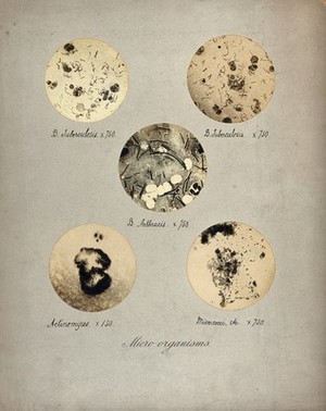 view Tuberculosis and anthrax bacilli, actinomyces and micrococci, seen through a microscope. Five photographs.