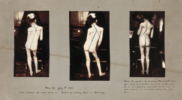 A girl with osteopathic problems, standing; three views. Photographs, 1899 - 1900.