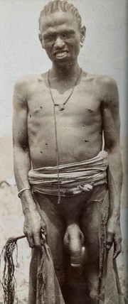 Standing man, front view, probably with elephantiasis of the scrotum, Abyssinia. Photograph, 1904.