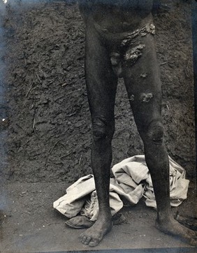 The legs of a man, naked, with skin growths on his left hip and thigh, Abyssinia. Photograph, 1904.