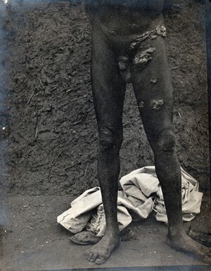 view The legs of a man, naked, with skin growths on his left hip and thigh, Abyssinia. Photograph, 1904.
