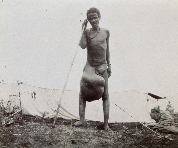 Abyssinia: a naked man with elephantiasis owing to oedema of the lymph nodes in the right groin. Photograph, 1904.