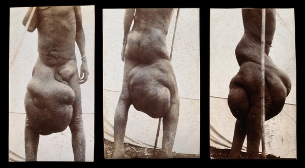 Abyssinia: a naked man with elephantiasis probably due to oedema of the lymph nodes in the right groin: three views, front, back and right side. Photograph, 1904.