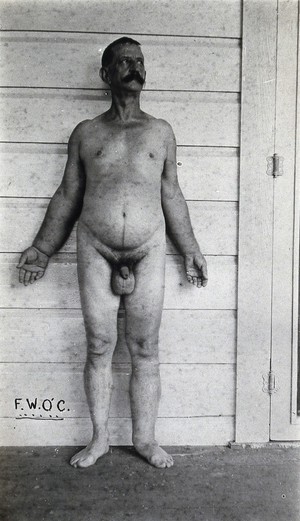 view A standing man, full-length front view, with elephantiasis of the left leg and possibly the right arm, Fiji . Photograph by F.W. O'Connor, 1920/1921.