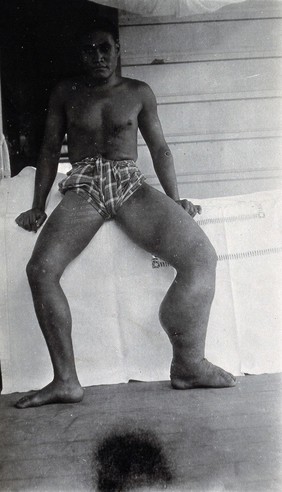 A seated man, full-length front view, with elephantiasis of the left leg, Fiji. Photograph by F.W. O'Connor, 1920/1921.