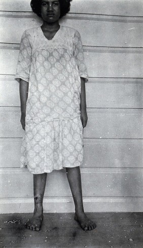 A standing woman, full-length front view, with a growth on her lower right leg, Fiji. Photograph by F.W. O'Connor, 1920/1921.