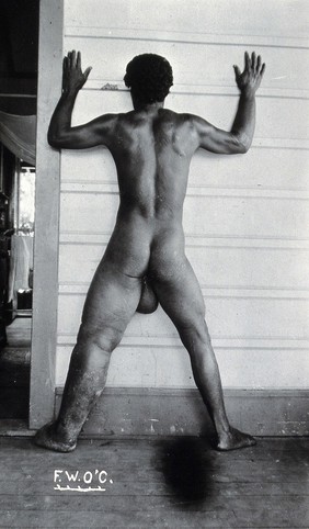 A standing man, full-length back view, with elephantiasis of the left leg and probably scrotum, Fiji. Photograph by F.W. O'Connor, 1920/1921.