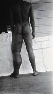 A standing man, full-length back view, with elephantiasis of the left leg, Fiji. Photograph by F.W. O'Connor, 1920/1921.