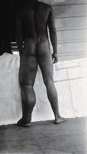 view A standing man, full-length back view, with elephantiasis of the left leg, Fiji. Photograph by F.W. O'Connor, 1920/1921.