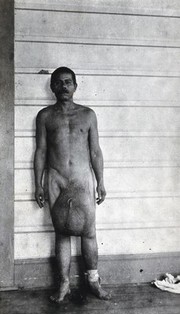 A standing man, full-length front view, with elephantiasis of the scrotum, Fiji. Photograph by F.W. O'Connor, 1920/1921.