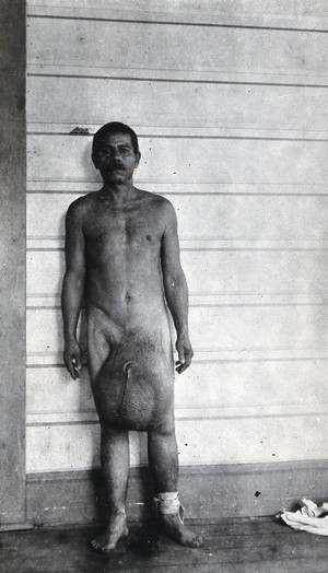 view A standing man, full-length front view, with elephantiasis of the scrotum, Fiji. Photograph by F.W. O'Connor, 1920/1921.