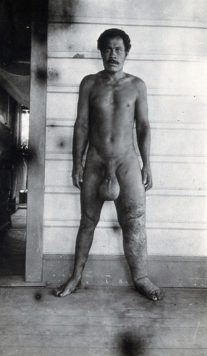 view A standing man, full-length side view, with elephantiasis of the left leg and scrotum, Fiji. Photograph by F.W. O'Connor, 1920/1921.