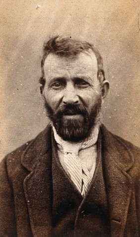 Peter Fitzsimons, a patient at West Riding Lunatic Asylum in Wakefield, Yorkshire. Photograph attributed to James Crichton-Browne, 1872.