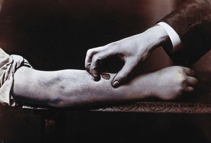 view A hand held over a dark mark on a forearm, to demonstrate the manual treatment of ulcers. Photograph.