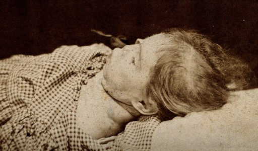 The head and shoulders of a child, showing signs of mental deficiency, seen in profile lying down. Photograph.
