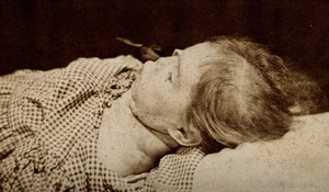 view The head and shoulders of a child, showing signs of mental deficiency, seen in profile lying down. Photograph by J. Keens.