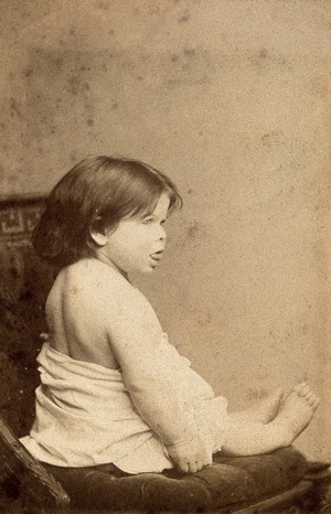 view A young child with protruding tongue, showing signs of mental deficiency, sitting on a large upholstered chair. Photograph by Davis.