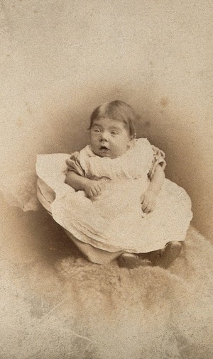 view A child showing signs of Down's syndrome sitting on a fur cushion. Photograph by J.H. Hogg.