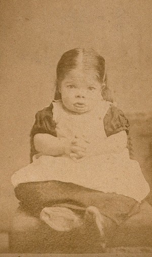 view A very young girl, showing signs of mental deficiency, seated with her hands clasped upon her lap. Photograph by W. Moscrop.