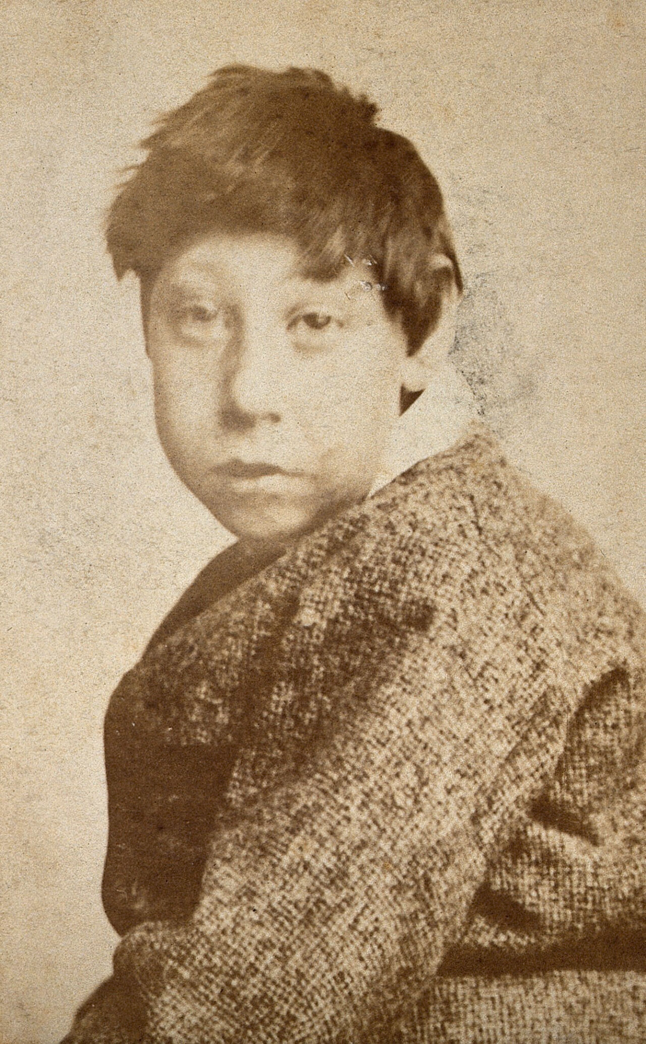 A young dark-haired boy, showing signs of mental deficiency, wearing a tweed coat, looking at the camera from over his left shoulder. Photograph by J. Davis., by John Davis