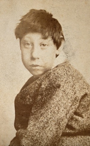 view A young dark-haired boy, showing signs of mental deficiency, wearing a tweed coat, looking at the camera from over his left shoulder. Photograph by J. Davis.