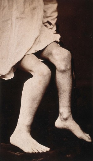 view The legs of a child, showing deformity in the bones, particularly around the knee. Photograph by E. Peers.